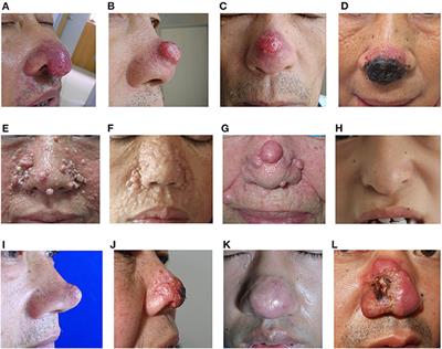 Update of Clown Nose-Like Lesion, a Underrecognized Manifestation of Metastatic Malignancies and Genetic Cancer Predisposition Syndromes